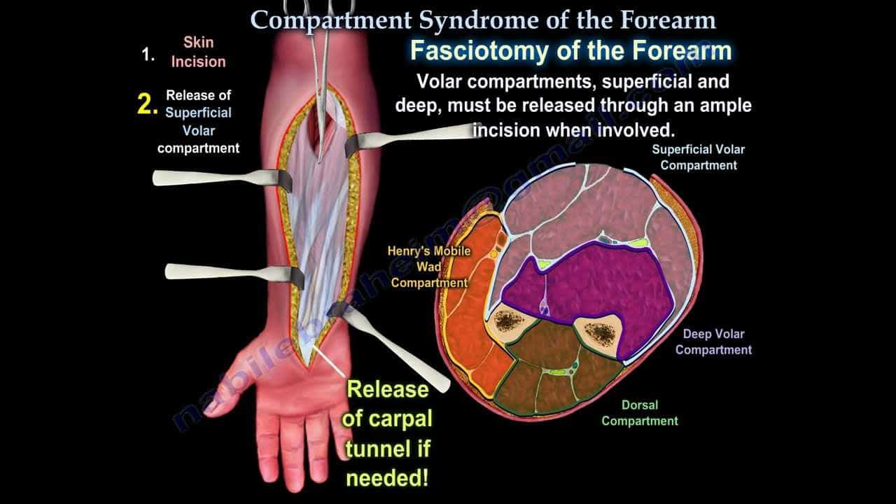 Compartment syndrome forearm